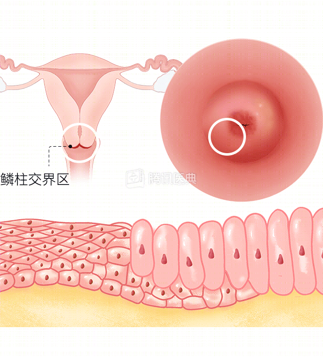 宫颈为何这么爱生病？女生最该了解的6个知识