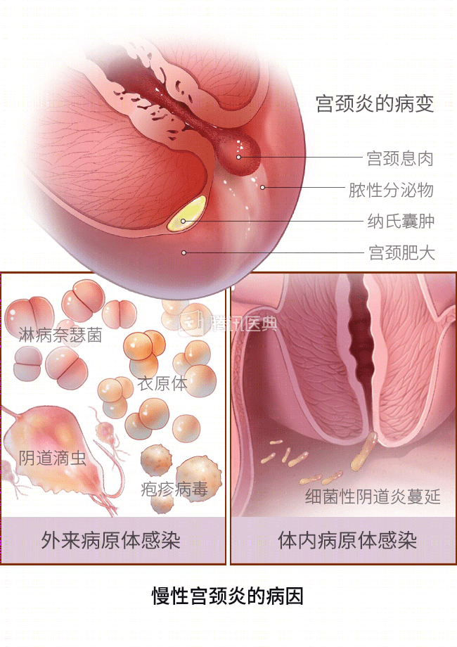 宫颈为何这么爱生病？女生最该了解的6个知识