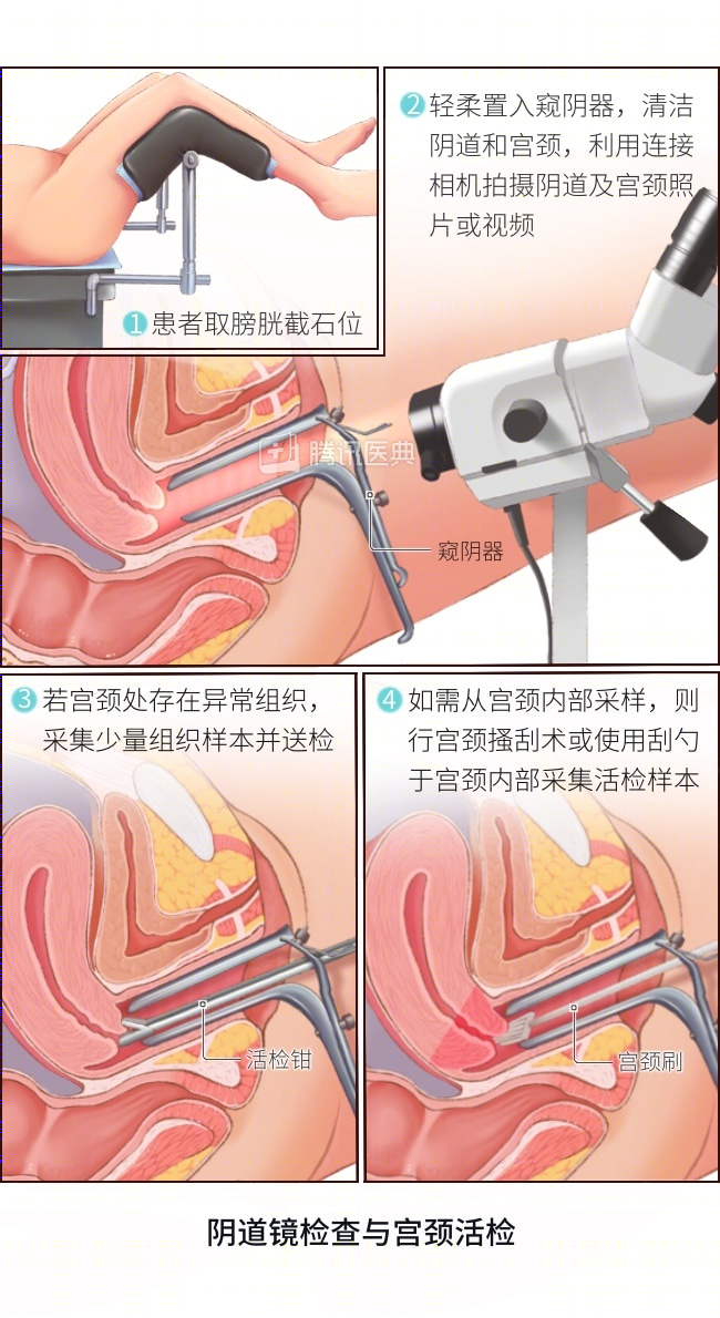 宫颈为何这么爱生病？女生最该了解的6个知识