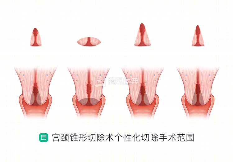 宫颈为何这么爱生病？女生最该了解的6个知识