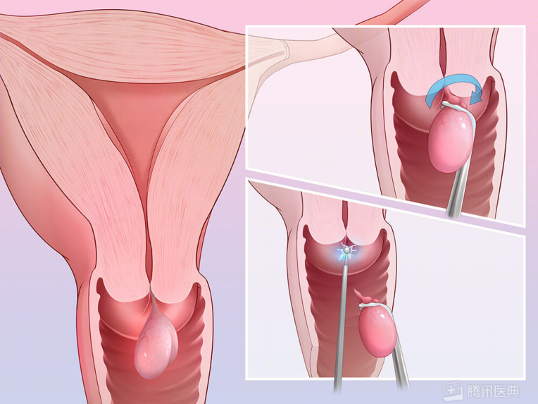 宫颈为何这么爱生病？女生最该了解的6个知识